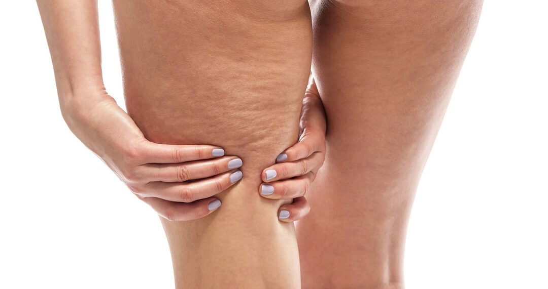 Stile di vita sano contro la cellulite